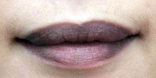 Cẩn thận với biến chứng môi thâm, răng đen