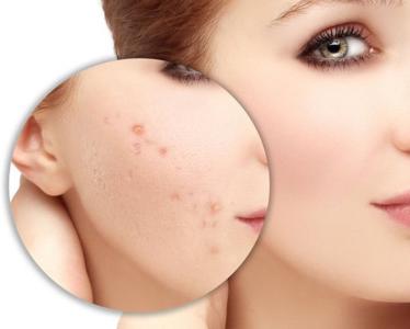 Lý do khiến da bạn bị thâm sau mụn