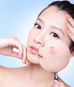 Thực phẩm giúp giảm mụn trứng cá mùa nắng nóng