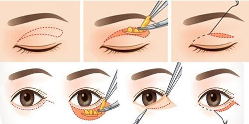 Nguyên tắc khi quyết định cắt mí