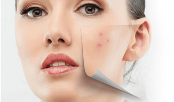 Bôi vitamin A trị mụn trứng cá, cần lưu ý gì?