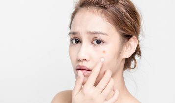 Chăm sóc da tránh mụn tuổi học trò