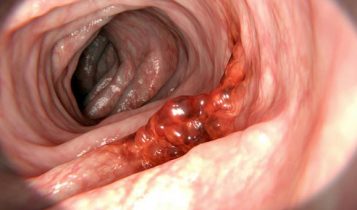 Dấu hiệu nhận biết ung thư dạ dày sớm