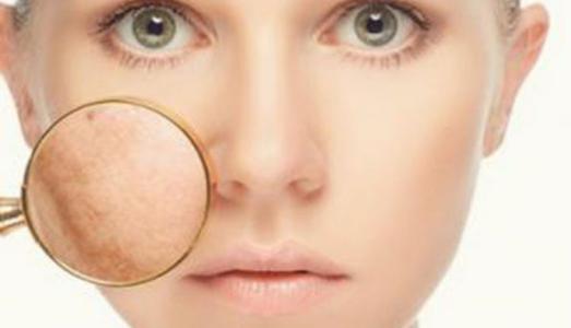 Chữa sạm da – rám má