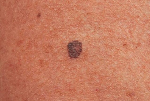 Nốt ruồi dần biến đổi theo 5 cách này, coi chừng tế bào ung thư trong cơ thể bạn