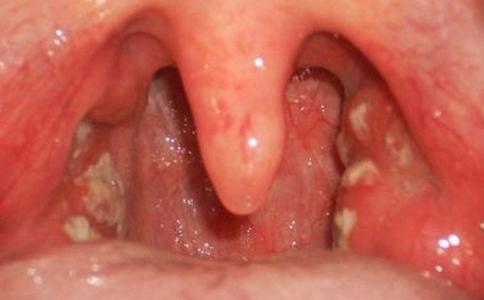 Bác sĩ lưu ý những điều quan trọng của bệnh bạch hầu