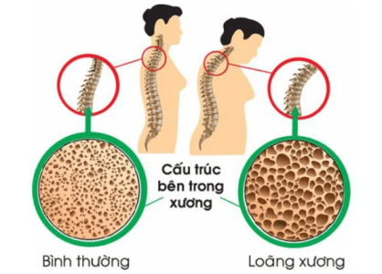 Dấu hiệu thiếu canxi cần bổ xung ngay