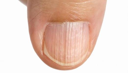 Dấu hiệu bệnh khi móng tay có kẻ dọc