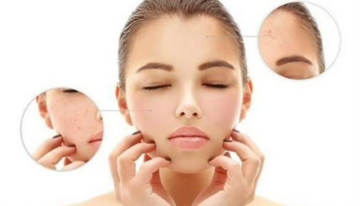 Điều cần lưu ý khi điều trị mụn cho da khô