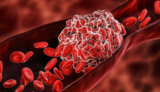 Di chứng nguy hiểm nhất hậu Covid-19 bác sĩ chỉ dấu hiệu phát hiện sớm