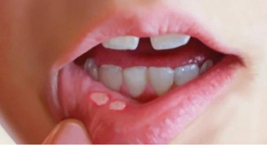 Viêm loét miệng không thể chủ quan, để lâu không khỏi rất dễ K miệng