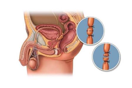 Ham muốn tình dục ở nam giới có giảm khi triệt sản?