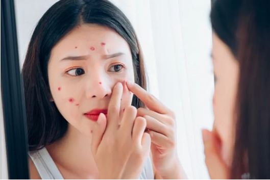 Mẹo làm sạch nhân mụn phục hồi làn da sáng khỏe