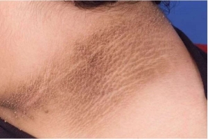 Dấu hiệu lạ ở cổ cảnh báo tế bào K tấn công cơ thể