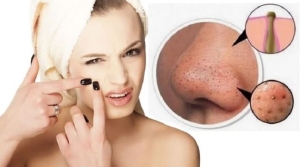 Điều cần chú ý khi trị mụn đầu đen tránh làm tổn thương da mặt