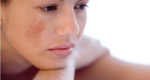 Kiểu trị nám để tránh làm tổn thương da