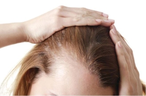 Mẹo loại bỏ gàu, giảm ngứa da đầu khi nắng nóng