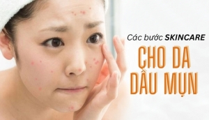 Gợi ý liệu trình skincare trị mụn từ các thương hiệu nổi tiếng mà giá bình dân
