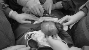 Cần biết về phẫu thuật ung thư buồng trứng