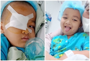 Kéo đập vào mắt, bé 4 tuổi bị rách giác mạc, vỡ thuỷ tinh thể 