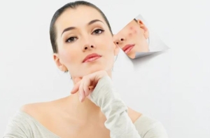 Mẹo chăm sóc da mụn ngày hè để để có làn da trắng sáng