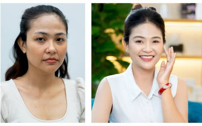 Lộ trình trẻ hóa da toàn diện của chị Mi tại Viện thẩm mỹ DIVA