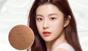 Mẹo xử lý sẹo rỗ phục hồi làn da căng mịn