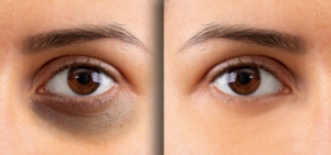 Mẹo giúp hết quầng thâm mắt