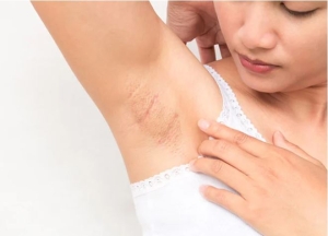 Tips đơn giản khắc phục nách bị thâm sạm, kém mịn màng