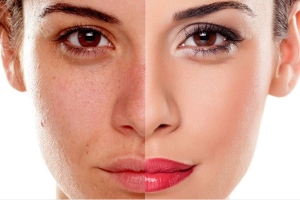 Cải thiện làn da xỉn màu cho chị em 