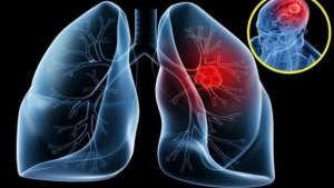 9 dấu hiệu ung thư phổi giai đoạn đầu đừng lơ là 