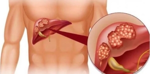 Nhóm người nên thực hiện tầm soát ung thư gan để bảo vệ sức khỏe