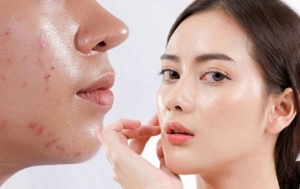 Kem chống nắng cho da dầu mụn khô thoáng, không bóng nhờn, không gây mụn