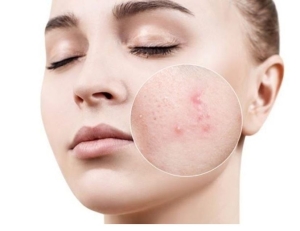  Trị mụn bọc chuẩn y khoa hiệu quả tại nhà, ngăn ngừa sẹo xấu