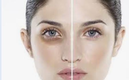 Sau bọng mắt và quầng thâm đen dưới mắt