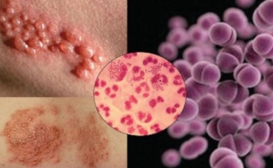 Bạn có biết 4 bệnh lây truyền qua đường tình dục không thể chữa khỏi hoàn toàn