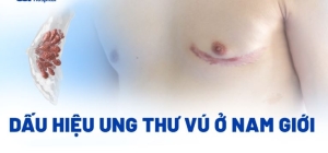 Ung thư vú ở nam giới không nên bỏ qua. 5 triệu chứng cảnh báo