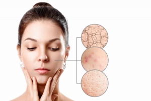 Những sản phẩm nên tránh cho làn da nhiều khuyết điểm, lỗ chân lông to