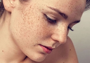 4 loại nám da thường gặp và cách điều trị