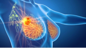 Chụp nhũ ảnh thường xuyên để phát hiện sớm ung thư vú?