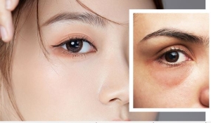 Tình trạng bọng mắt. Ghim ngay 5 cách phục