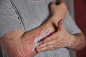 Kiêng gì khi bị viêm da dị ứng 