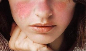 Hiểu đúng để không hoang mang khi da đẩy mụn khi dùng retinol