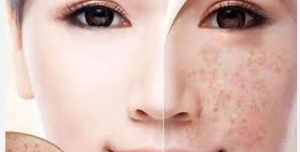 Nguyên nhân, dấu hiệu và cách cải thiện hiệu quả đốm đồi mồi trên da