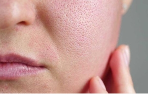 Lỗ chân lông to và cách chăm sóc da phù hợp cho từng nguyên nhân