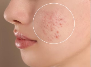 Miếng dán mụn sau khi nặn 6 lợi ích và cách dùng đúng để tránh thâm sẹo