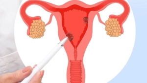 Hội chứng buồng trứng đa nang Hội chứng buồng trứng chuyển hóa đa nội tiết