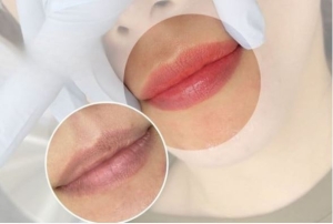 Khử thâm môi bằng laser