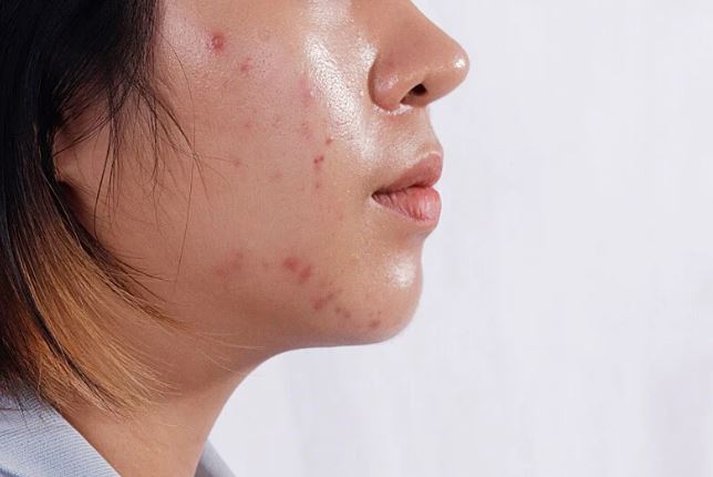 4 thói quen nhiều người mắc phải khiến da dầu dễ nổi mụn