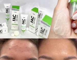 Giải pháp chăm sóc da mụn không chứa AHA, BHA